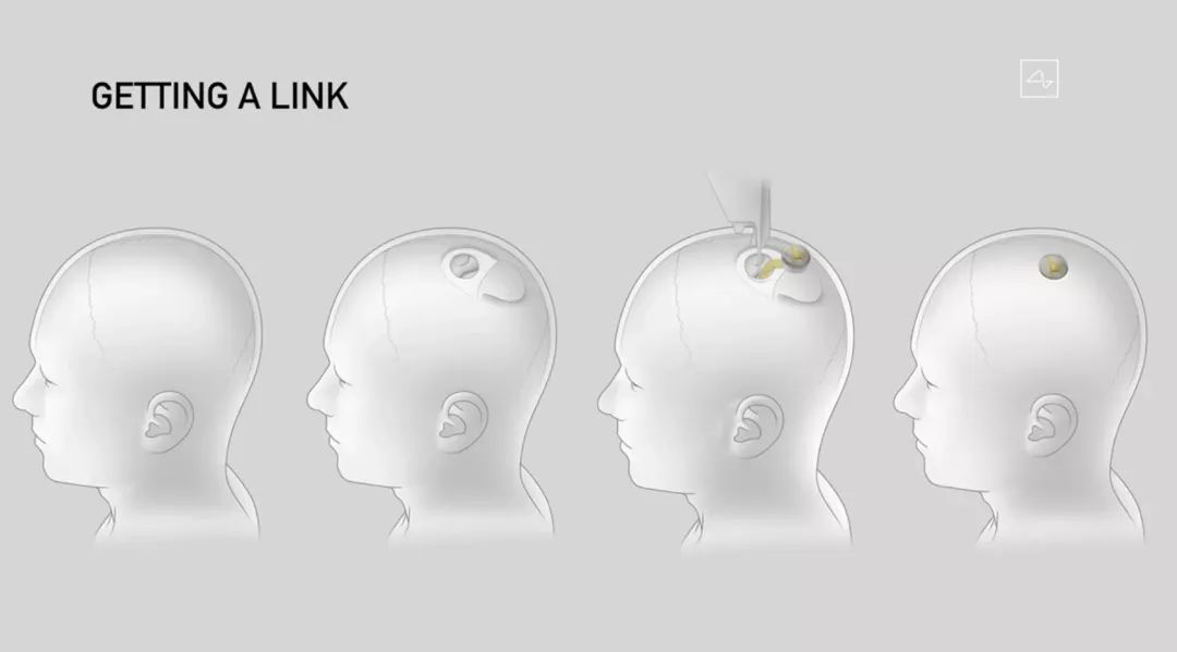 馬斯克發(fā)布腦機(jī)接口重大突破！藍(lán)牙連接，一小時(shí)植入，終極目標(biāo)是實(shí)現(xiàn)數(shù)字永生！